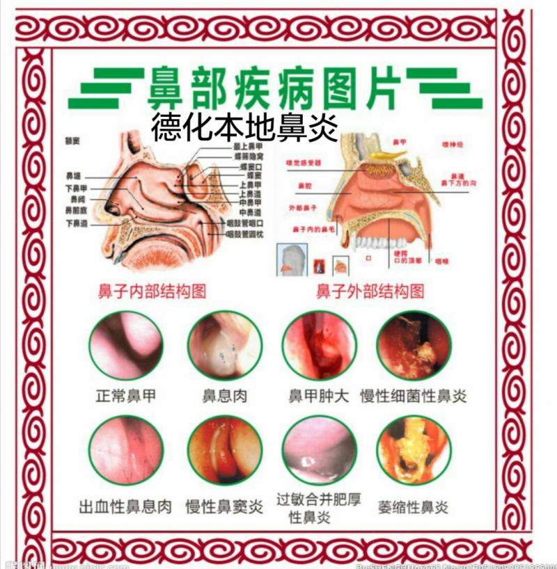 德化本地鼻息肉鼻甲肥大专业去除效果看得见地址德化陶瓷街林